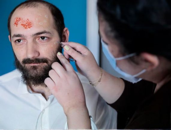 Varicose Veins Treatment